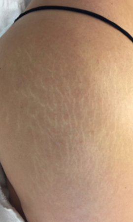 Striae 2