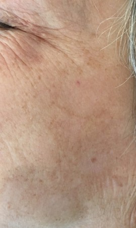 Traitement Taches Pigmentaires 13