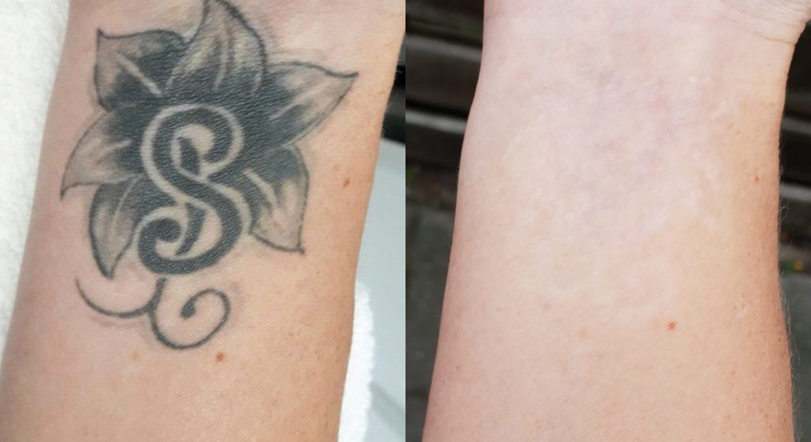 Tatoeage Verwijderen Resultaat