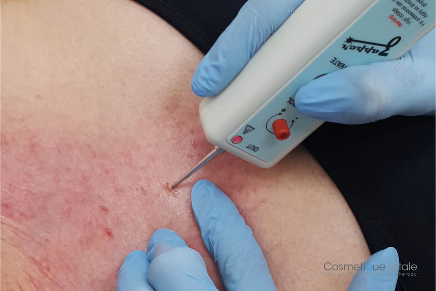 Zonneschade Behandeling Zapper