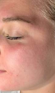 Résultat D'acne 12