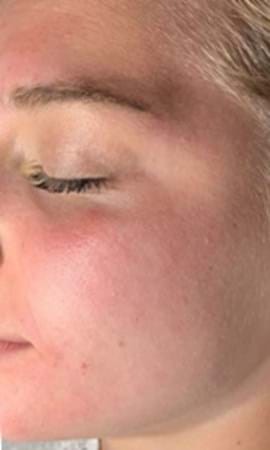 Résultat D'acne 12