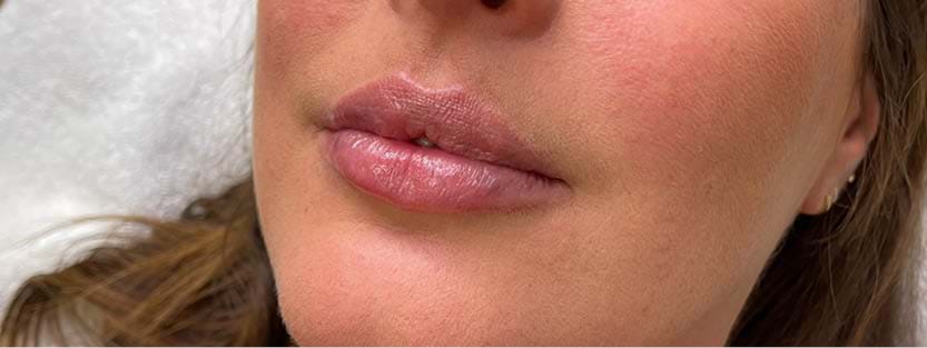 Lipfillers (1)