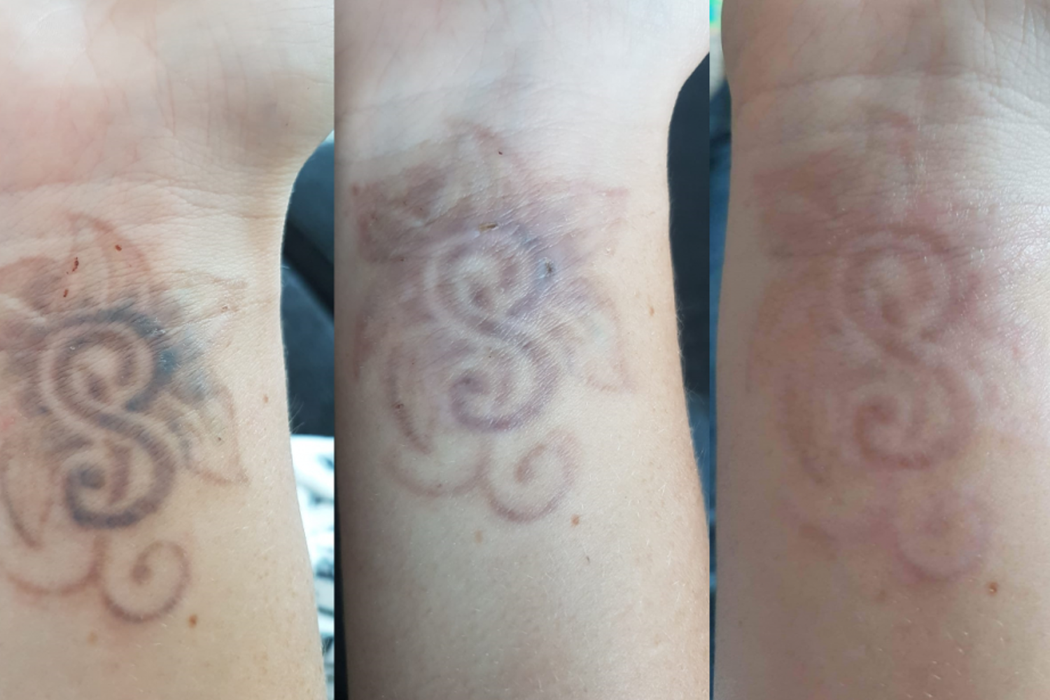 Tattoo Verwijderen Ervaring