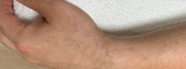 Resultaat Tattoo Verwijderen Na 5 Beh