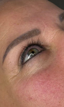 Resultaat Onder Oog Behandeling 1