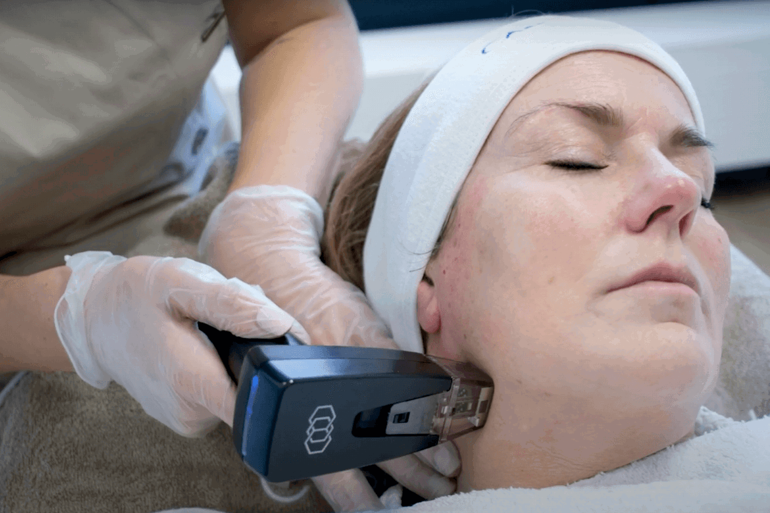 Hoe Gaat De Morpheus8 Behandeling In Z’N Werk