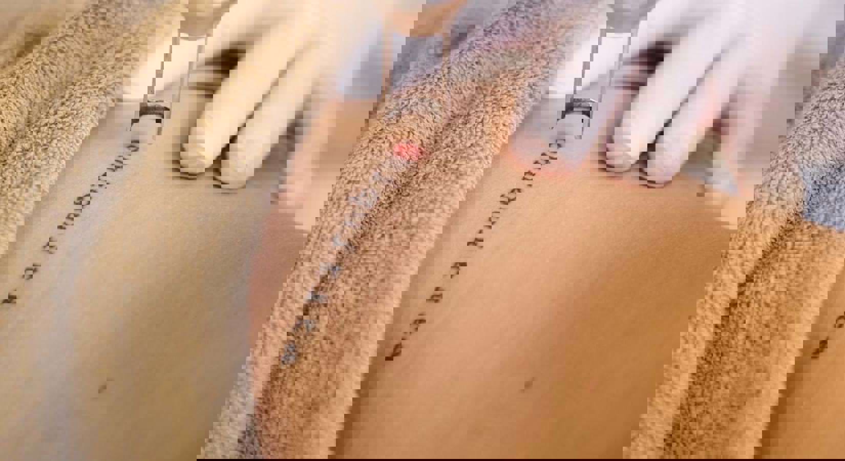 Tattoo Verwijderen Haarlem