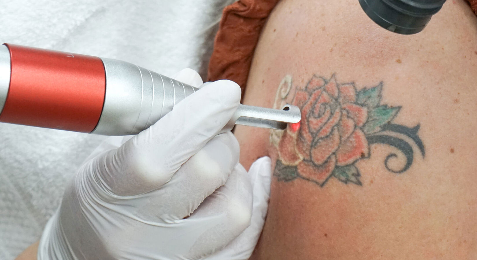 Gekleurde Tattoos Verwijderen, Kan Dat