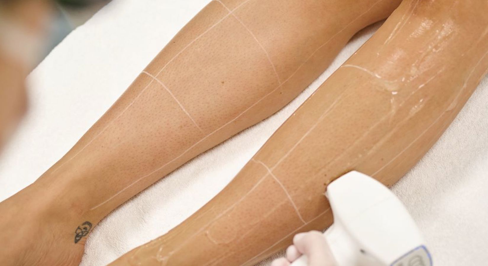 Diode Laser Ontharing