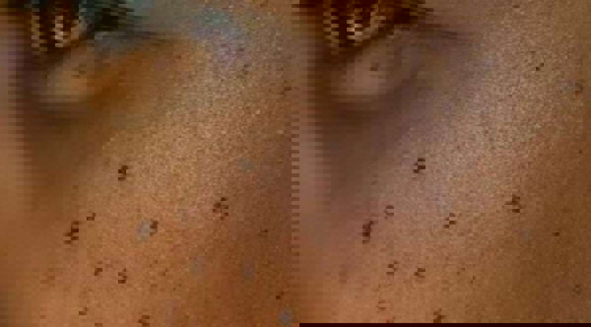 Grains de beauté, points de beauté. Crédit photo : Cosmétique totale.