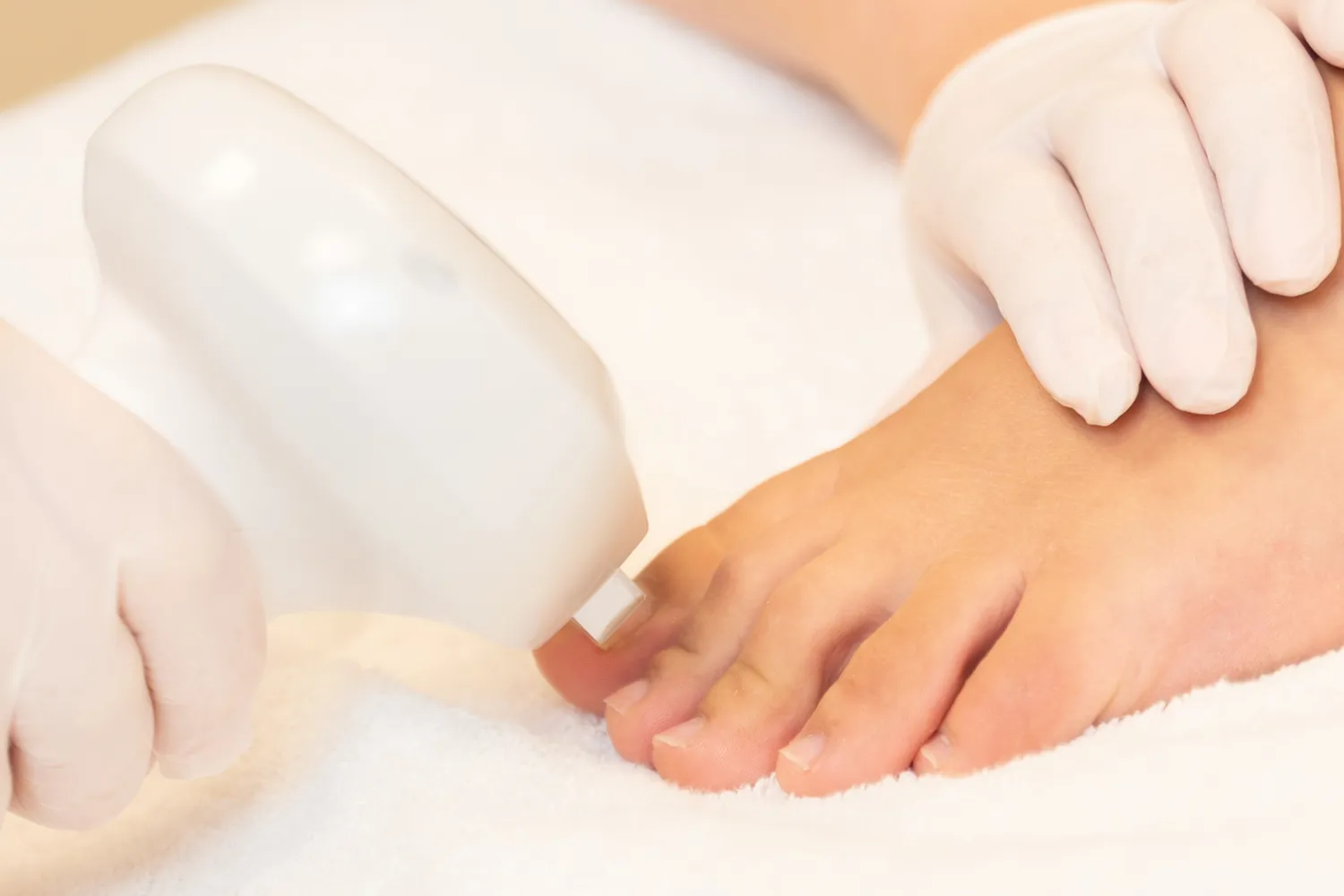 Mycoses Des Ongles Bordeaux