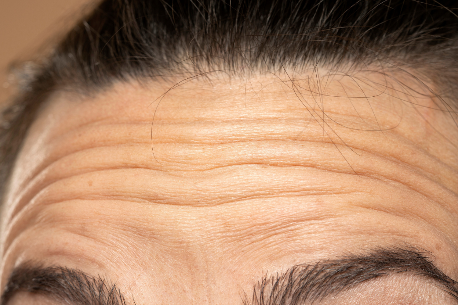 Botox Rimpels Voorhoofd
