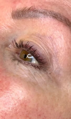 Total Eye Result 1 Before