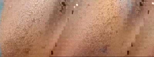 Ergebnis Nach 1 Behandlung