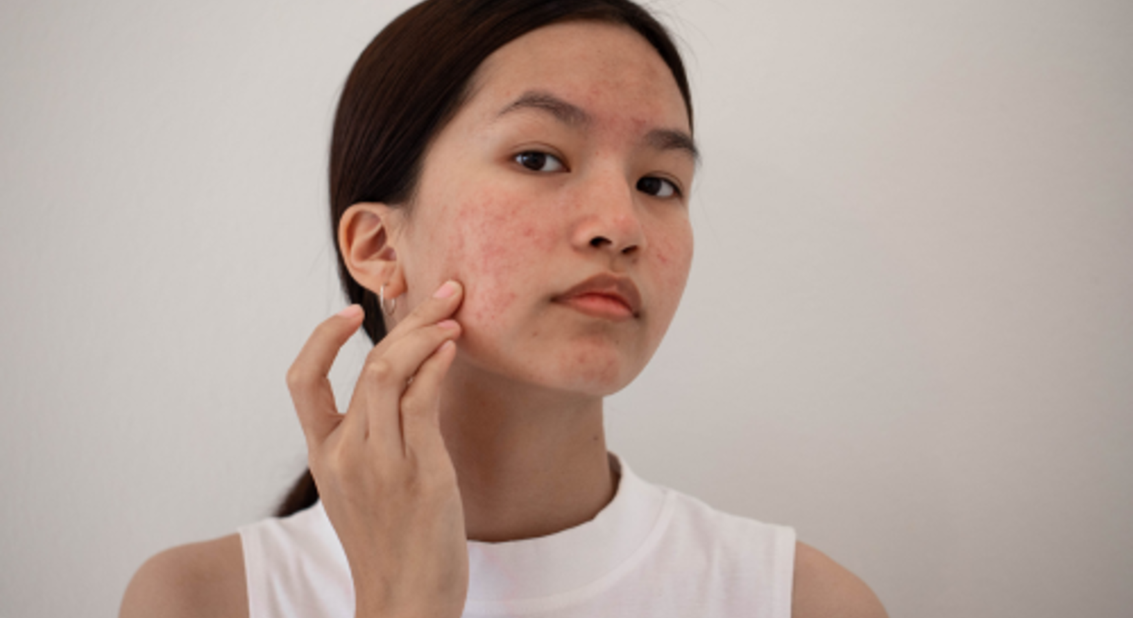 Acne Begrijpen, Voorkomen En Behandelen 1