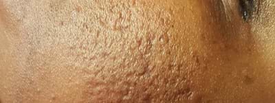Résultat Cicatrices D'acne 1