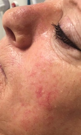 Cosmetique Totale Couperose (2)