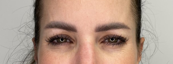 Botox Frons 2