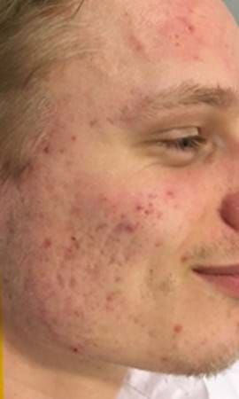 Résultat Cicatrices D'acne 3
