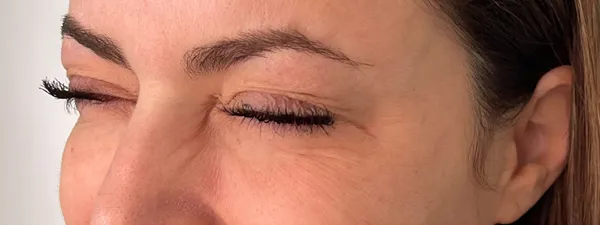 Botox Apres