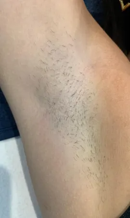 resultat epilation laser Lille