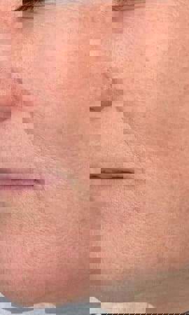 Ergebnis Einer Laserbehandlung