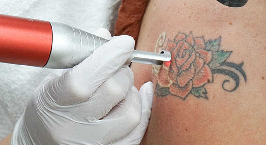 Tattoo Verwijderen