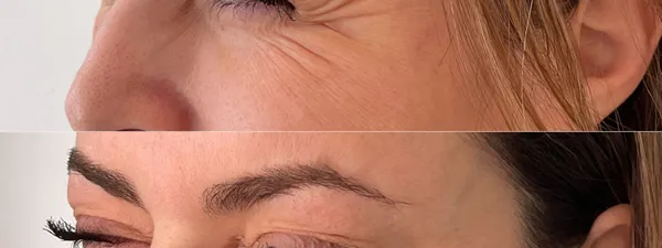 Botox Avant