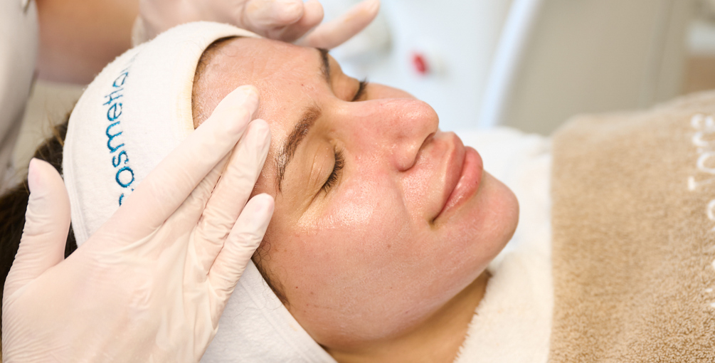Microneedling Voor Een Egale Huid