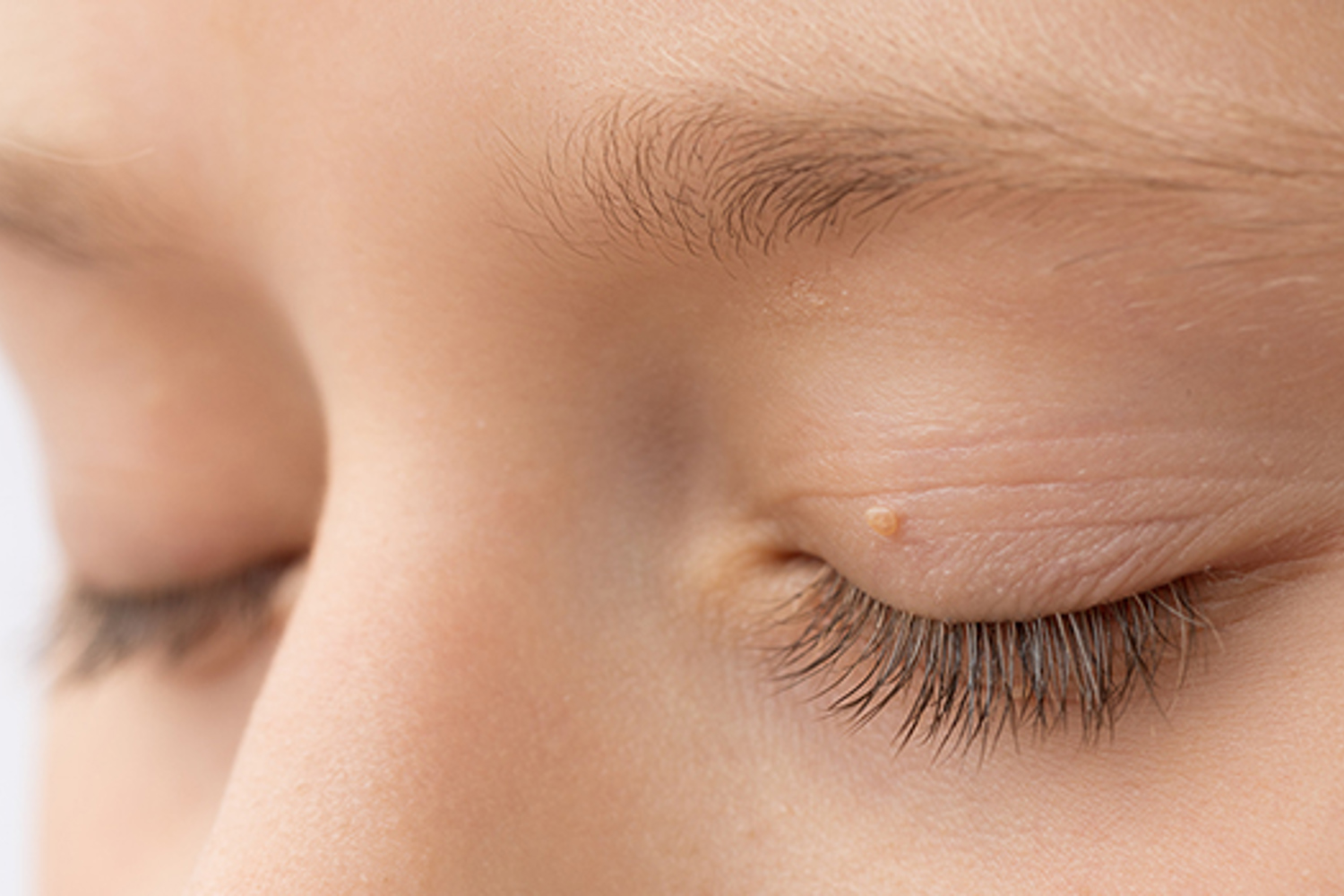 Fibromen En Ouderdomswratjes Behandeling 2
