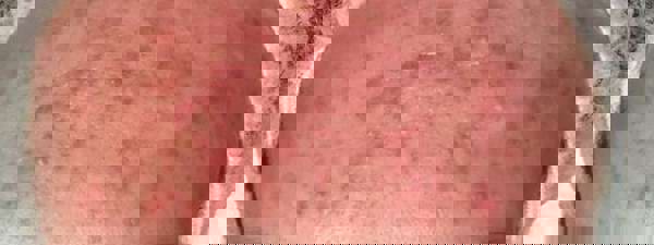 Ergebnis 4 Behandlungen