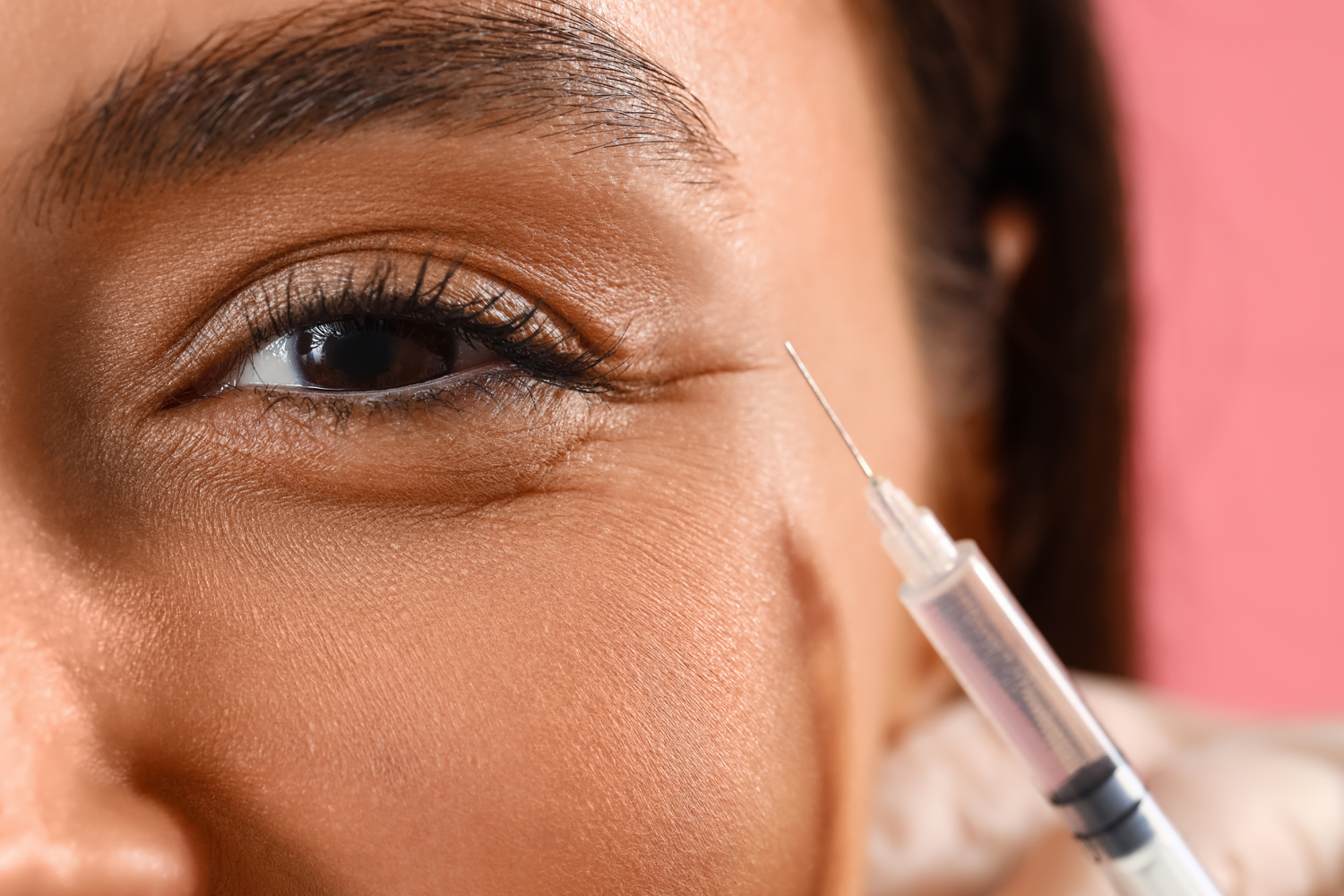 Méthode avec des fillers de sillon lacrymal