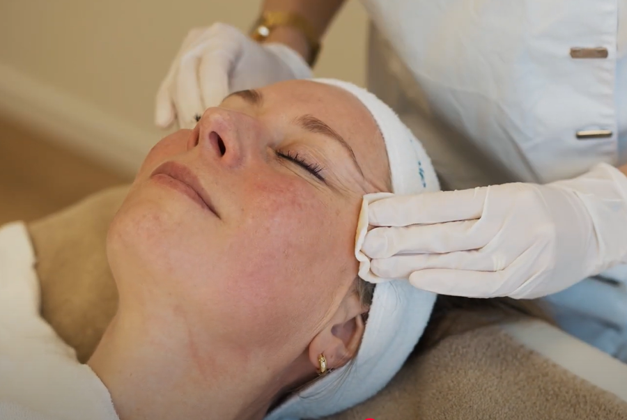 Rosacea laserbehandeling in de kliniek: huidtherapeut behandelt roodheid en vaatjes met medische apparatuur