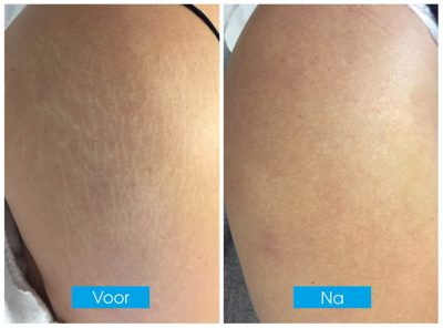 Ervaring Striae Verwijderen