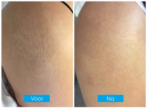 Ervaring Striae Verwijderen