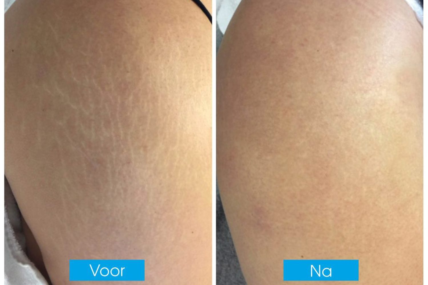Ervaring Striae Verwijderen