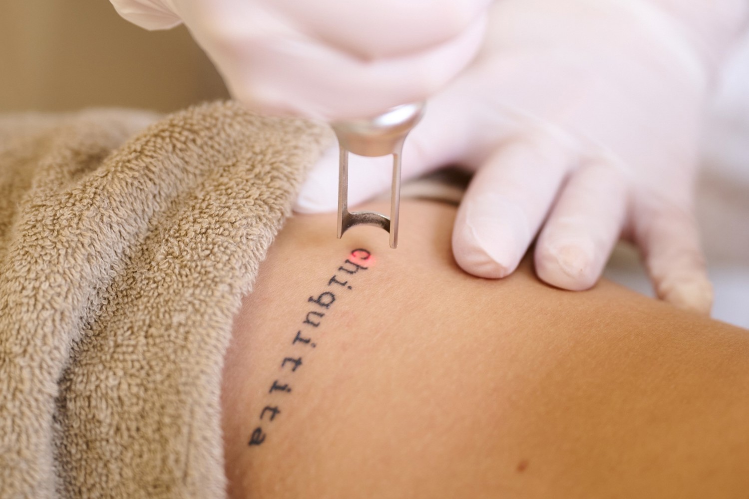 Tattoo Verwijderen Korting