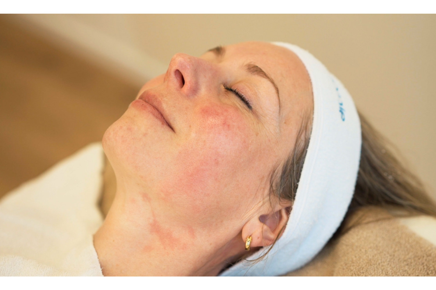 Rosacea Behandeling (3)