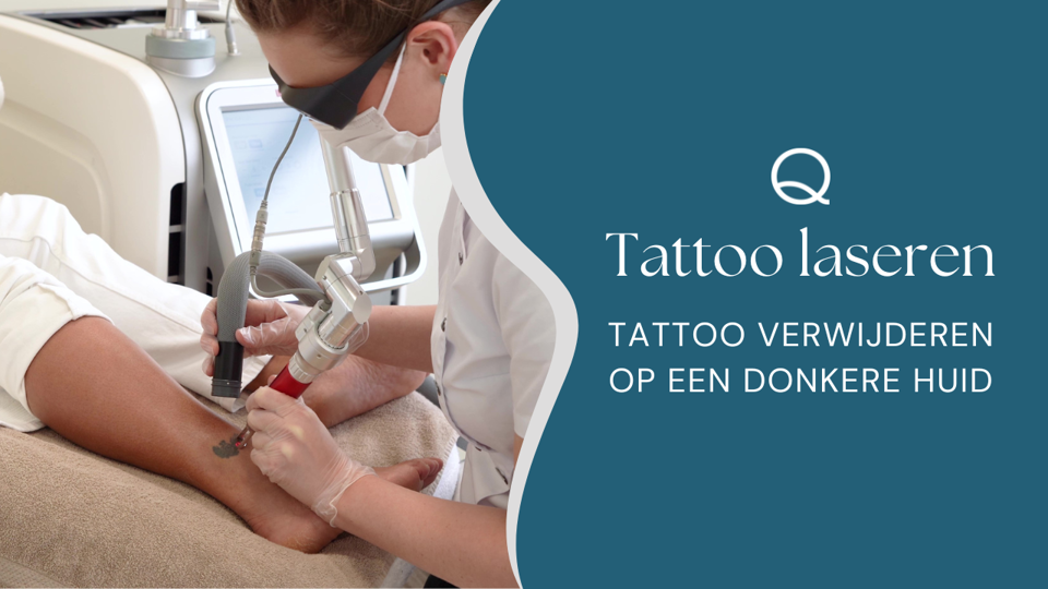 Tattoo Verwijderen Op Een Donkere Huid (1)