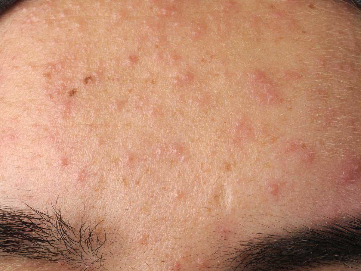 Pickel auf der Stirn Ursachen und Lösungen für klare Haut
