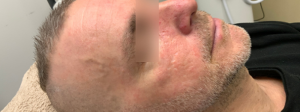 Resultaat Rosacea Behandeling 2