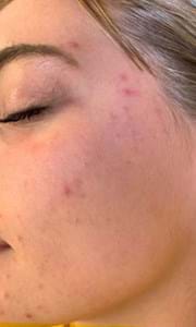 Résultat D'acne 1