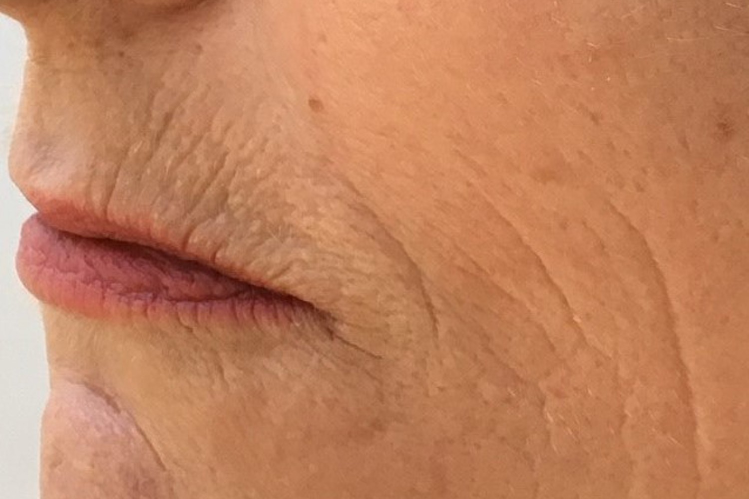 Voici ce que fumer fait votre peau Voici ce que fumer fait votre peau
