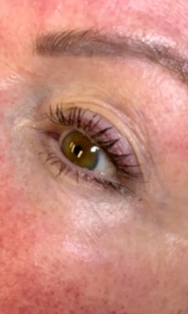 Total Eye Result 1 After