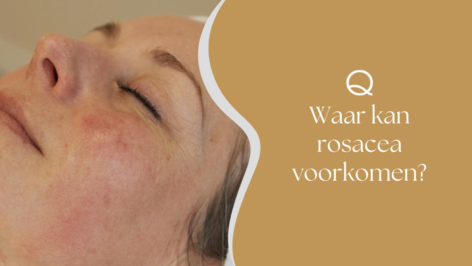 Waar Kan Rosacea Voorkomen