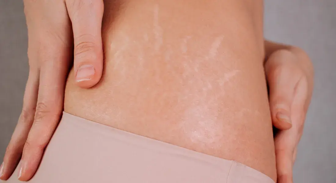 Wat Is Striae (1)