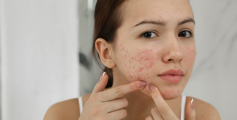 Feiten En Fabels Acne