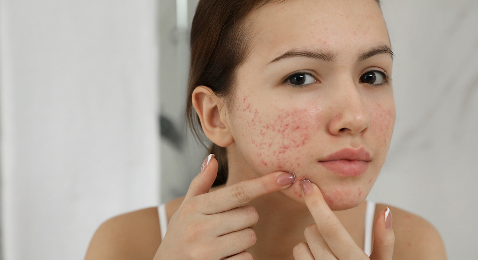 Feiten En Fabels Acne