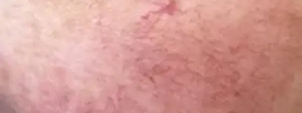 Couperose Behandelen Resultaat